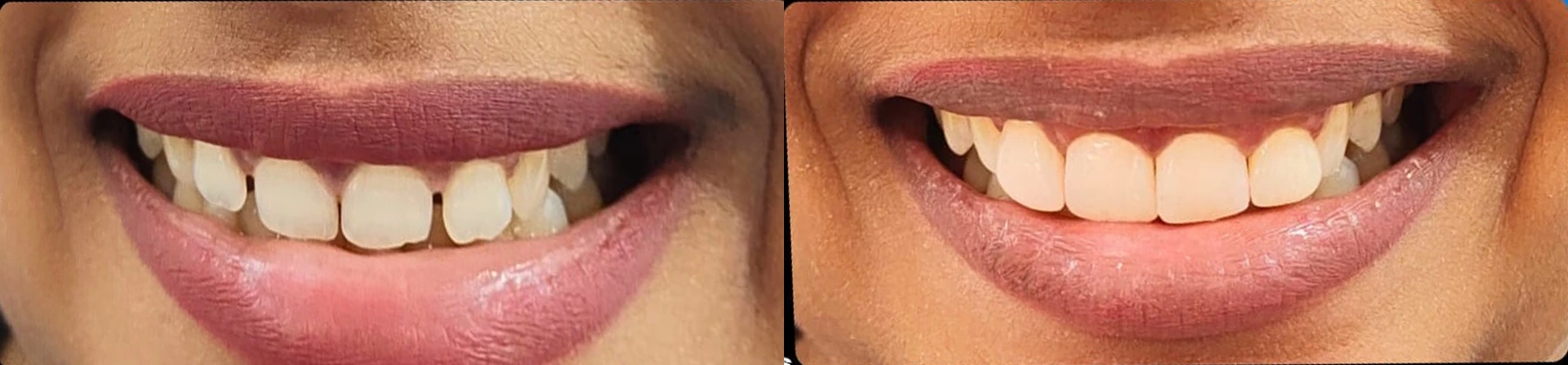 Smile designing case: original smile before treatment on the left and post-treatment smile on the right